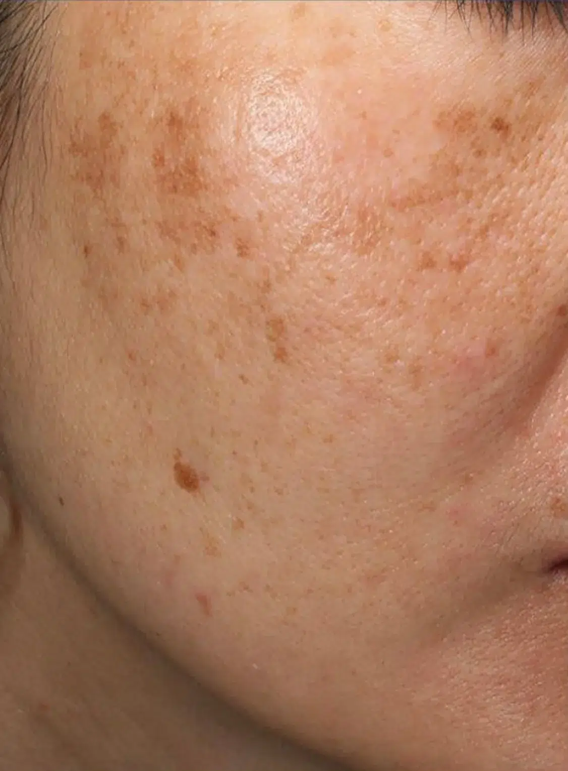 Pigmentation Before · Case 09 · Luowei Medical Aesthetics Clinic