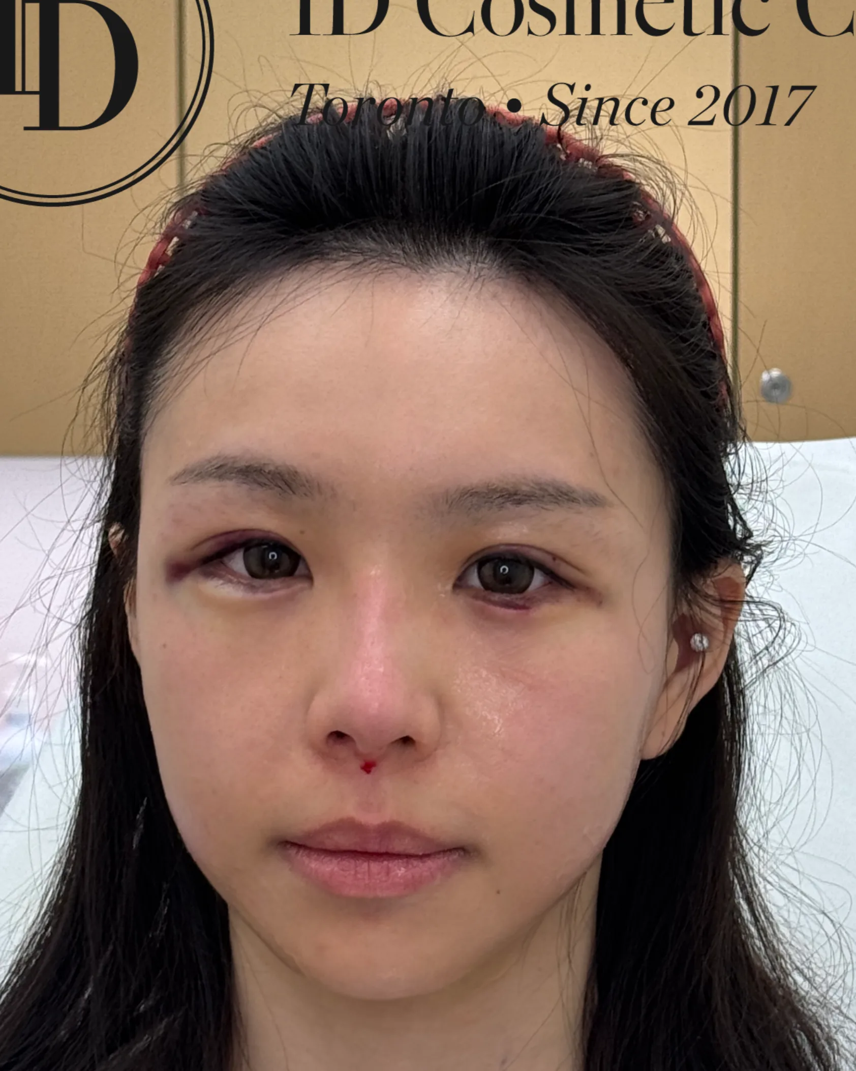 Upper eyelid ptosis — after treatment · Case 05 · Luowei Medical Aesthetics Clinic