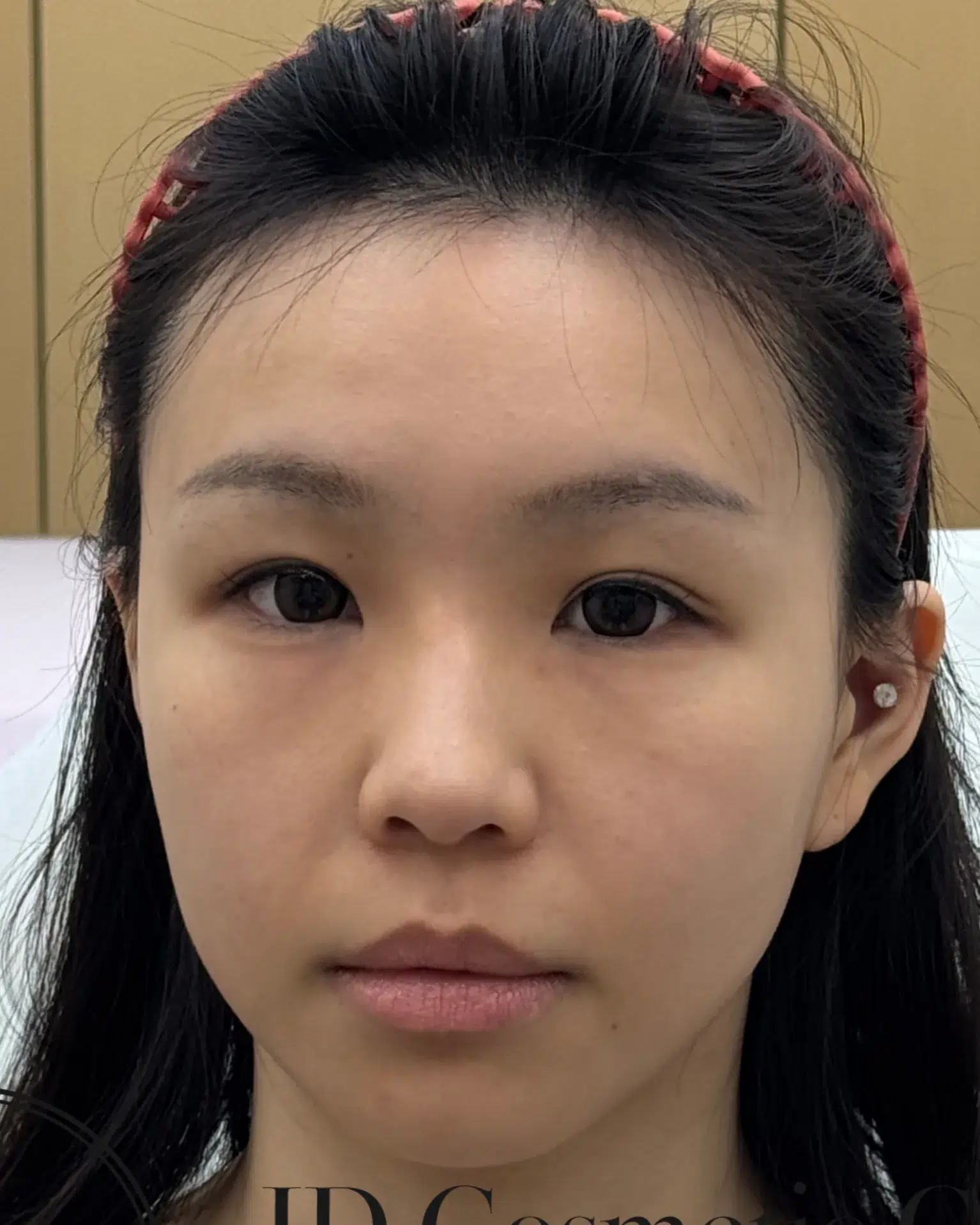 Upper eyelid ptosis — before treatment · Case 05 · Luowei Medical Aesthetics Clinic