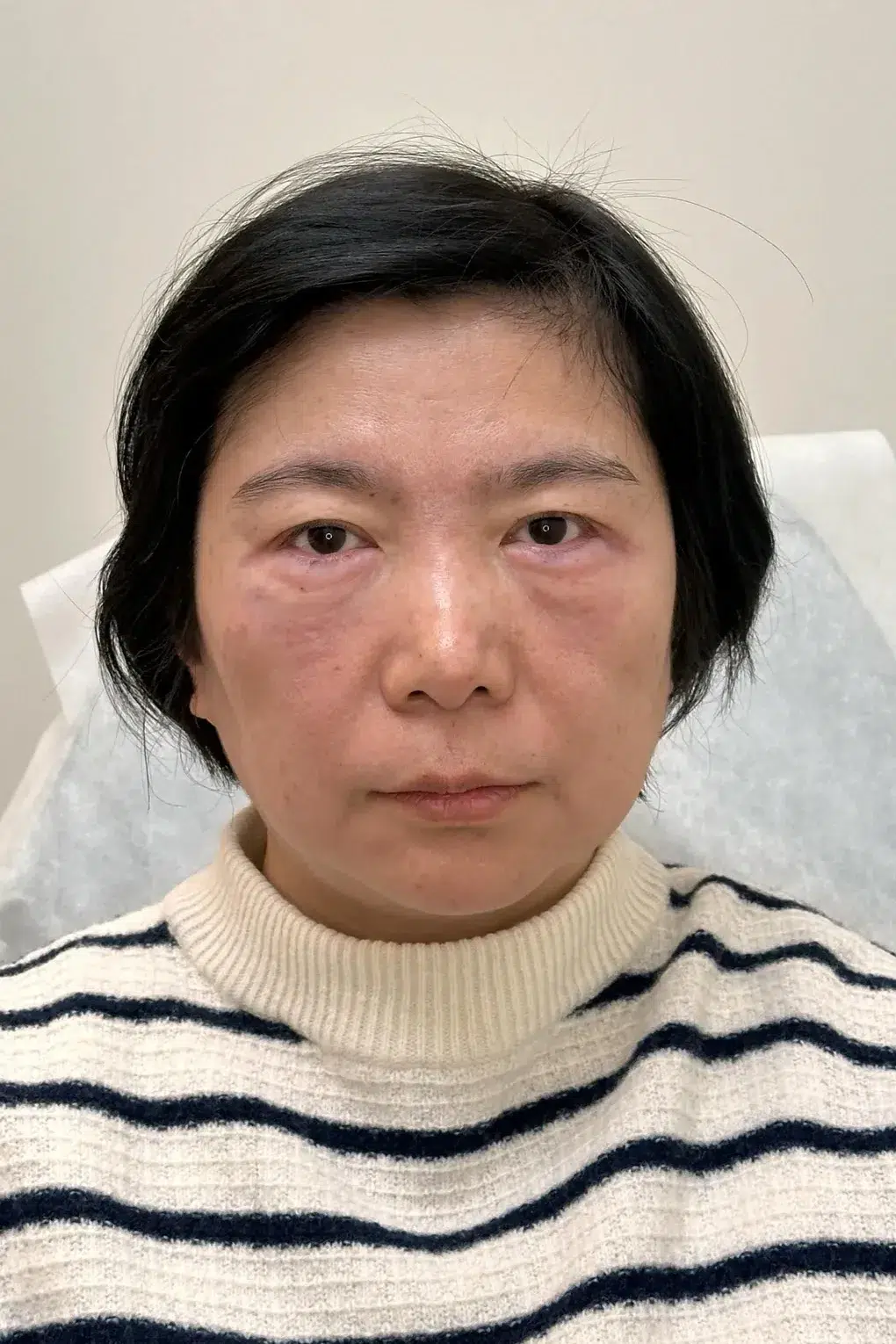 Facial Fatigue / Aged Appearance / Tired Look — After · Case 01 · Luowei Medical Aesthetics Clinic