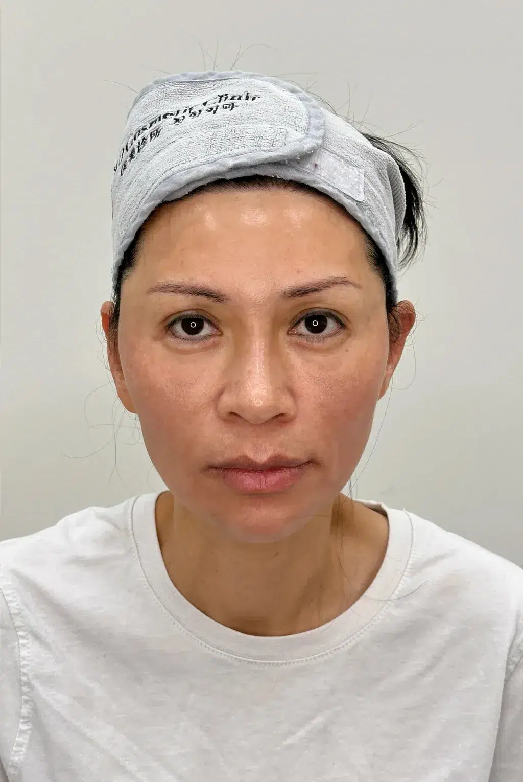 Facial Fatigue / Aged Appearance / Dull Complexion — After · Case 03 · Luowei Medical Aesthetics Clinic