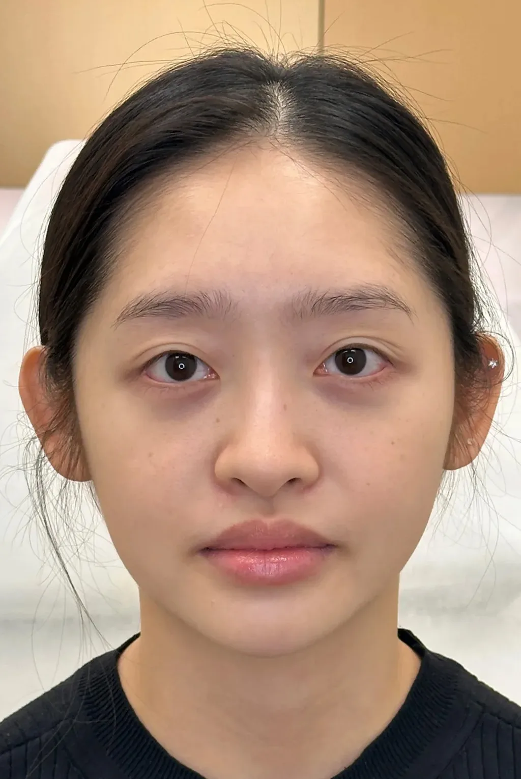 Under-Eye Bags & Dark Circles — After Treatment · Case 13 · Luowei Medical Aesthetics Clinic