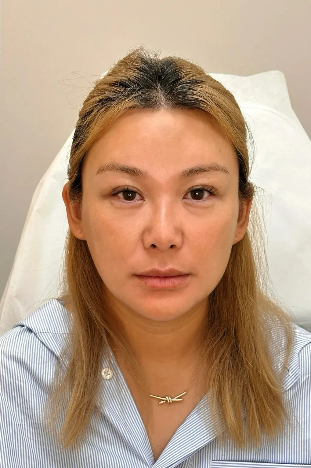 Tired, Aged & Fatigued Appearance — After Treatment · Case 08 · Luowei Medical Aesthetics Clinic