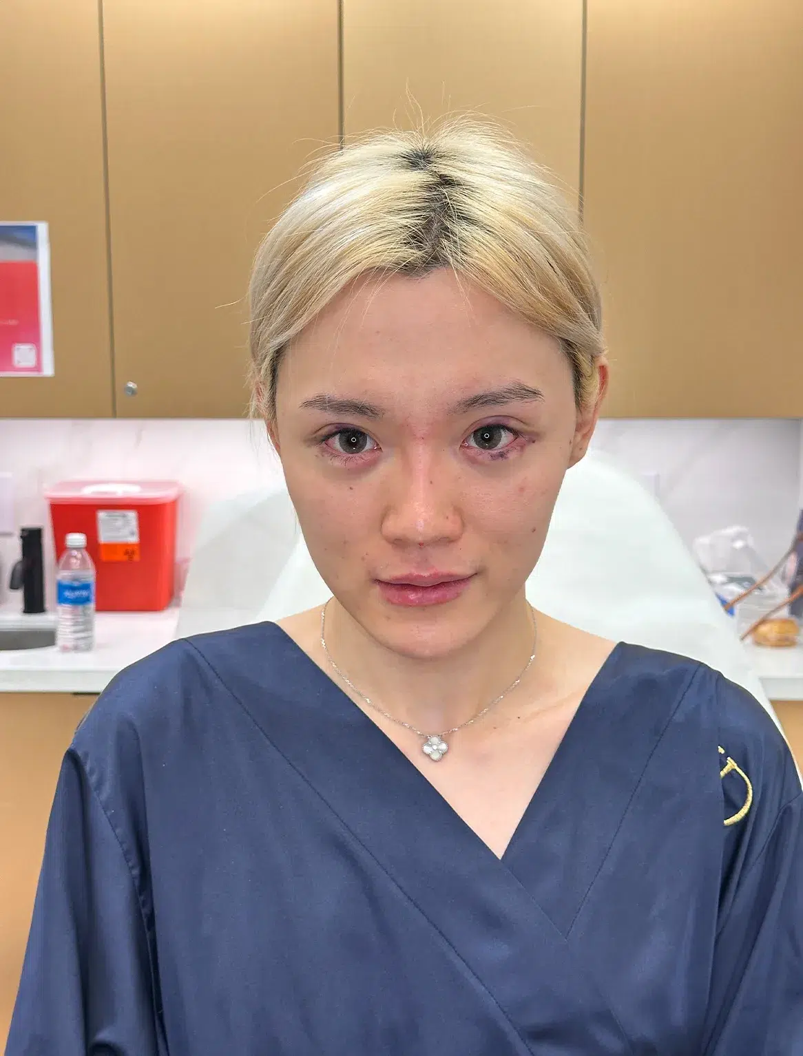 Upper Eyelid Ptosis — After · Case 09 · Luowei Medical Aesthetics Clinic