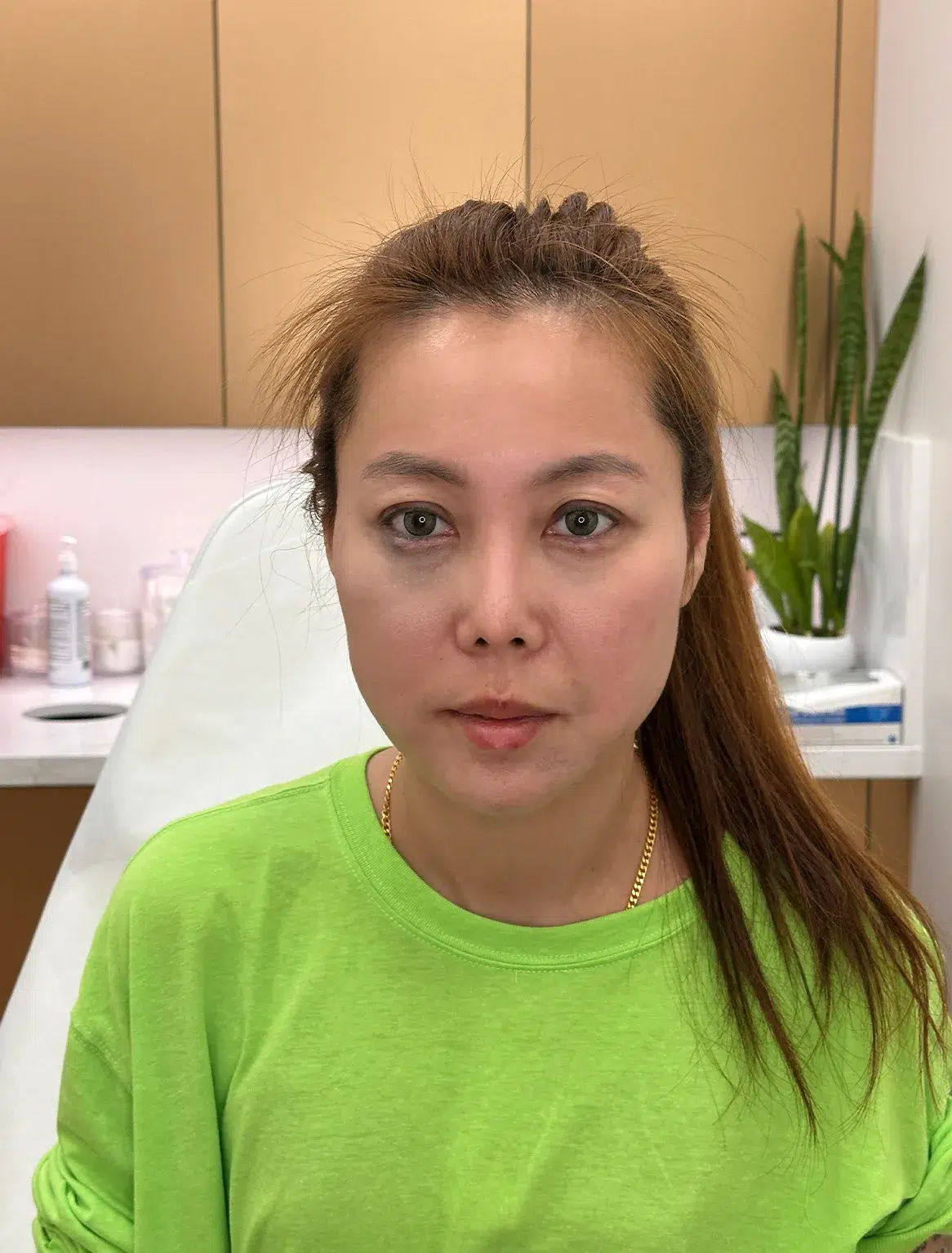 Facial Fatigue / Aged Appearance / Dull Complexion — After · Case 10 · Luowei Medical Aesthetics Clinic