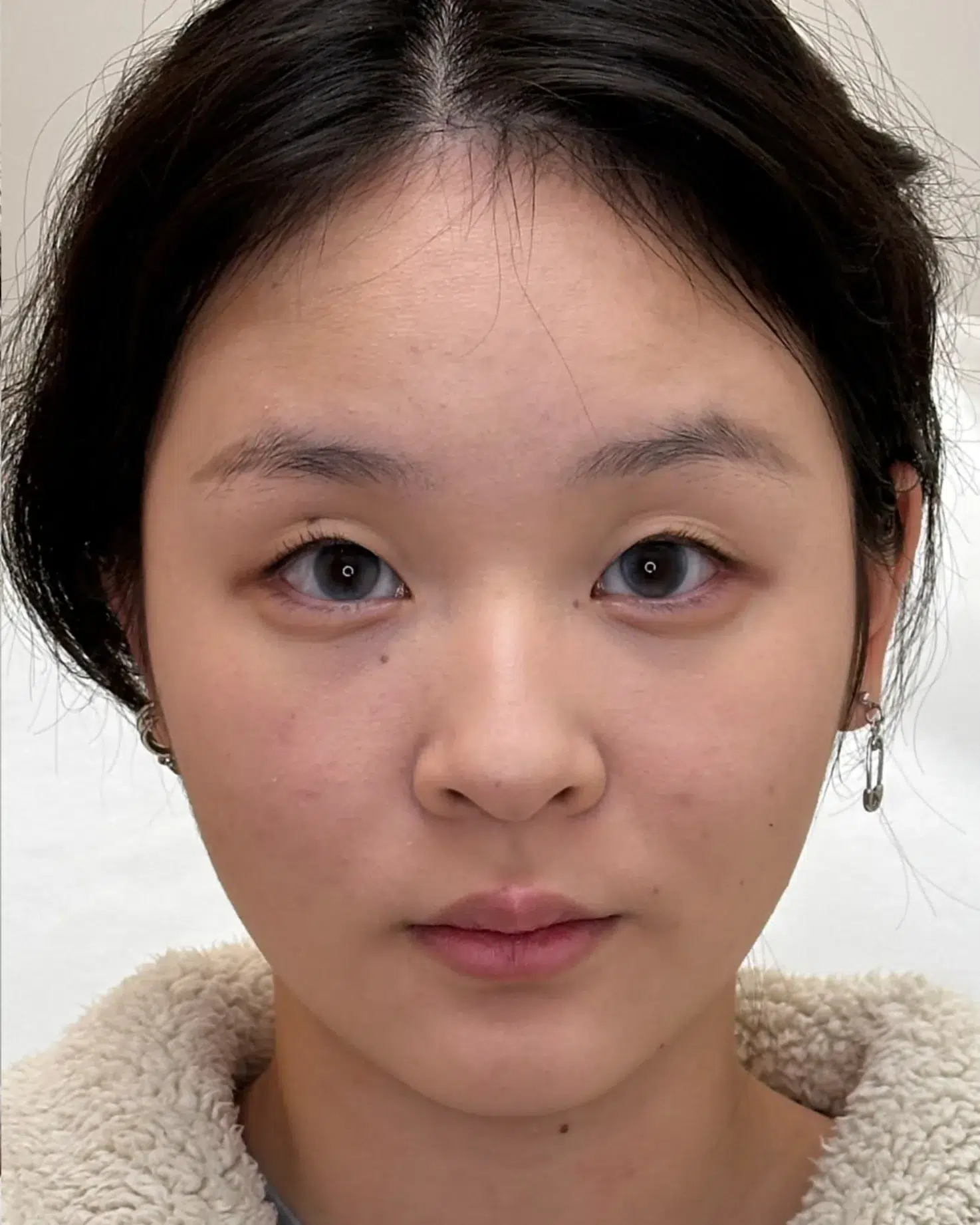 Luowei Skeletal Facial Contouring — After · Case 101 · Luowei Medical Aesthetics Clinic