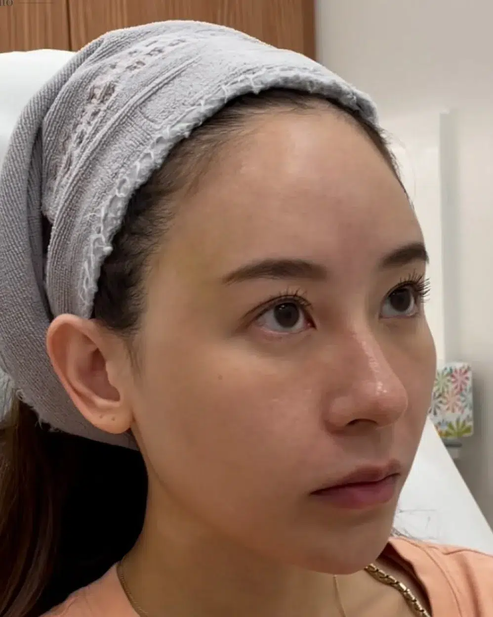 Tear Trough After Treatment · Case 104 · Luowei Medical Aesthetics Clinic