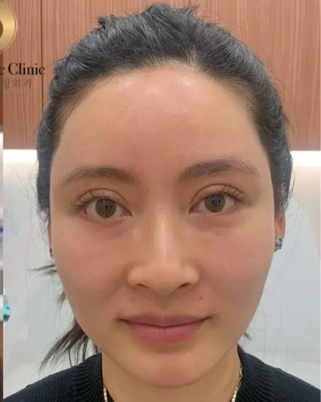 Tired, Aged & Fatigued Appearance — After Treatment · Case 106 · Luowei Medical Aesthetics Clinic