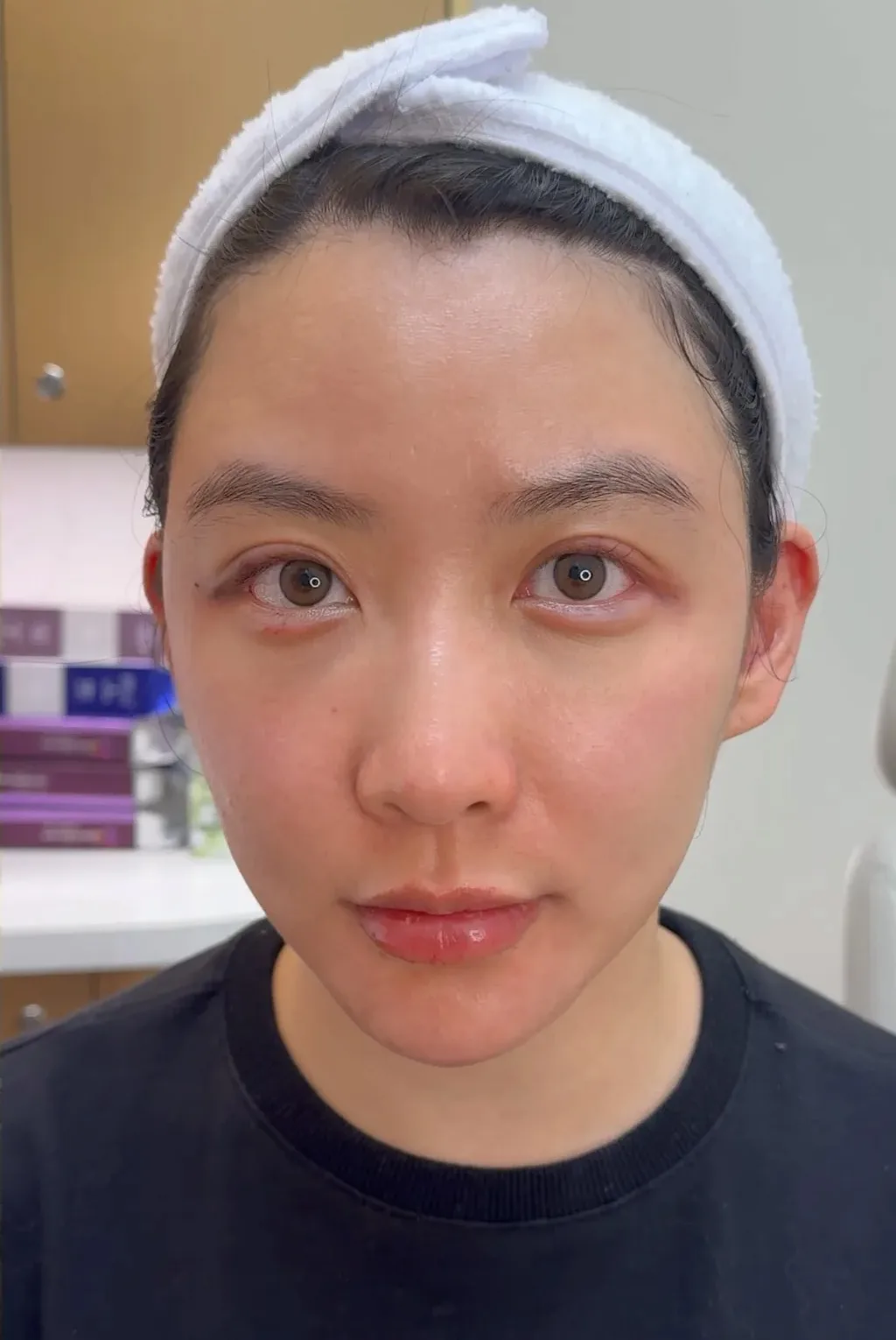 Under-Eye Bags & Dark Circles — After · Case 5 · Luowei Medical Aesthetics Clinic