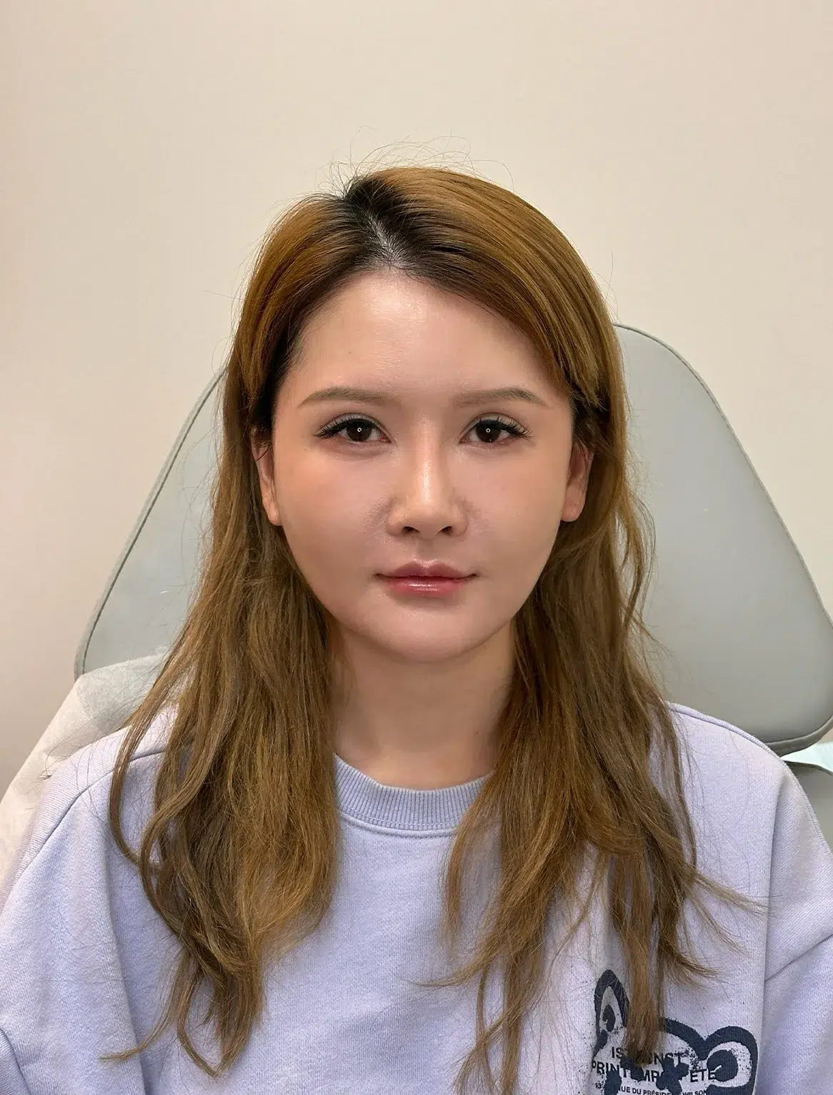 Facial Fatigue / Aged Appearance / Tired Look — After · Case 11 · Luowei Medical Aesthetics Clinic