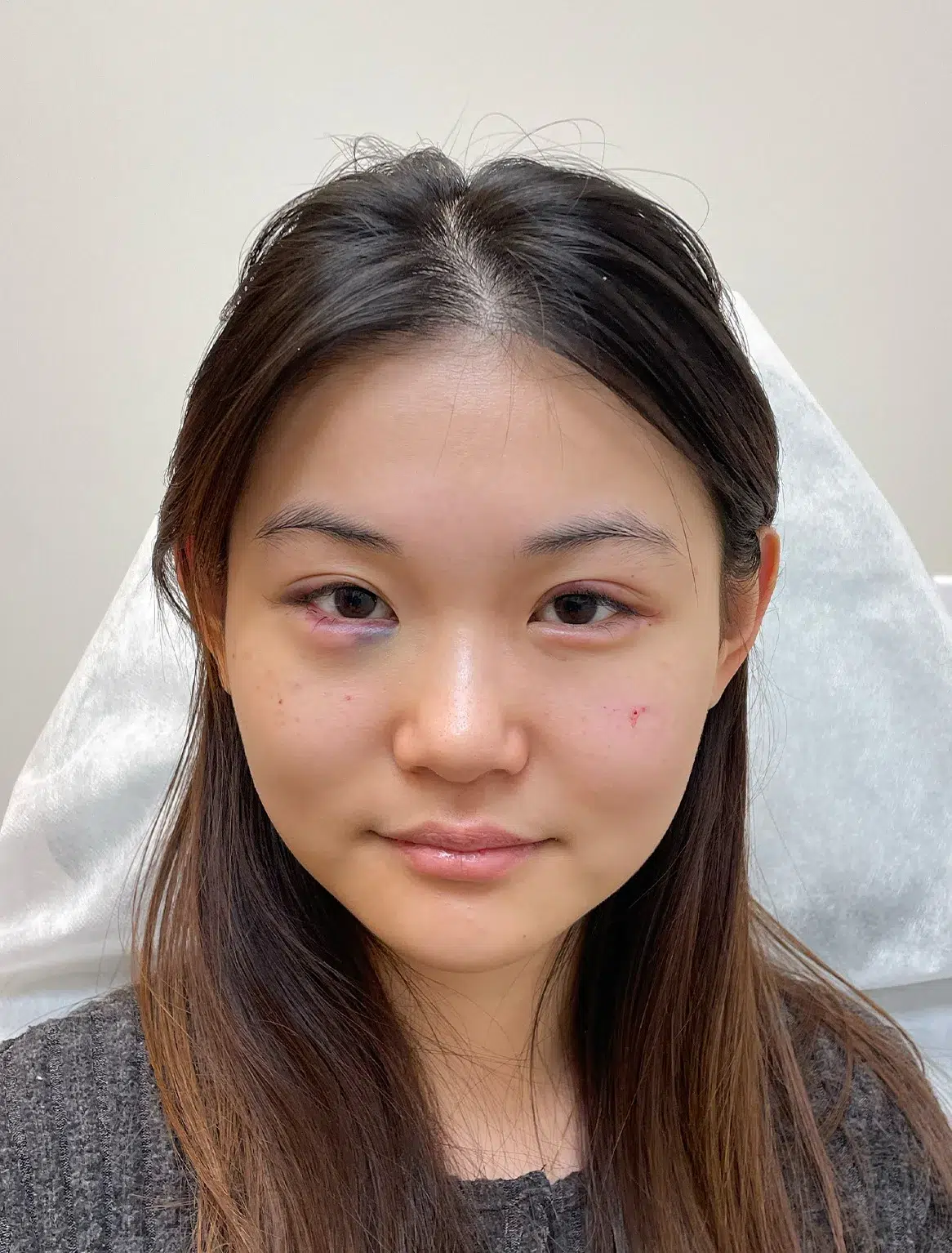 Ptosis (upper eyelid droop) — After · Case 13 · Luowei Medical Aesthetics Clinic