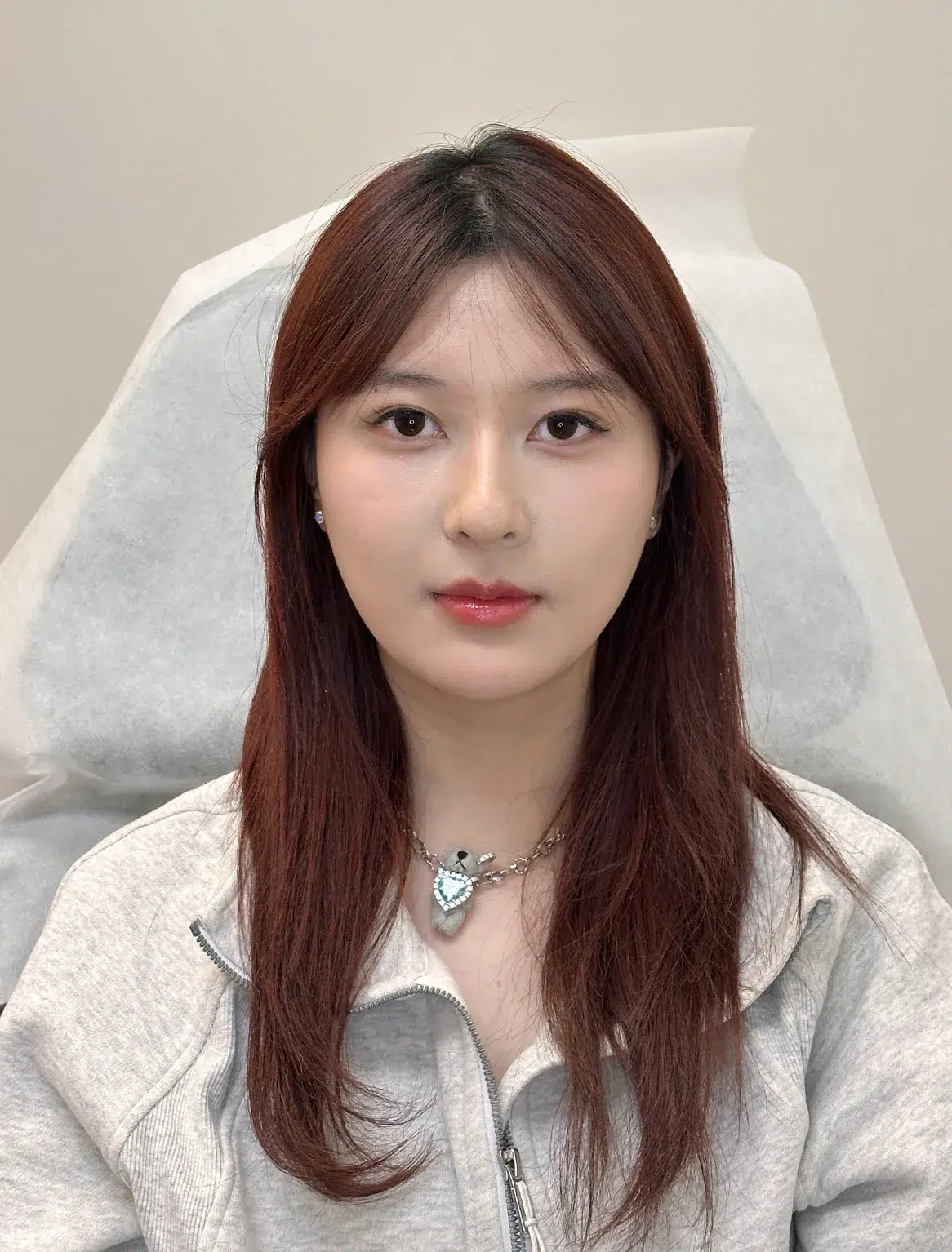 Tired, Aged & Fatigued Appearance — After Treatment · Case 14 · Luowei Medical Aesthetics Clinic