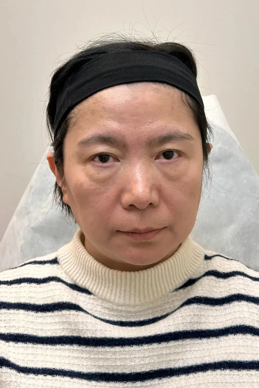 Facial Fatigue / Aged Appearance / Tired Look — Before · Case 01 · Luowei Medical Aesthetics Clinic