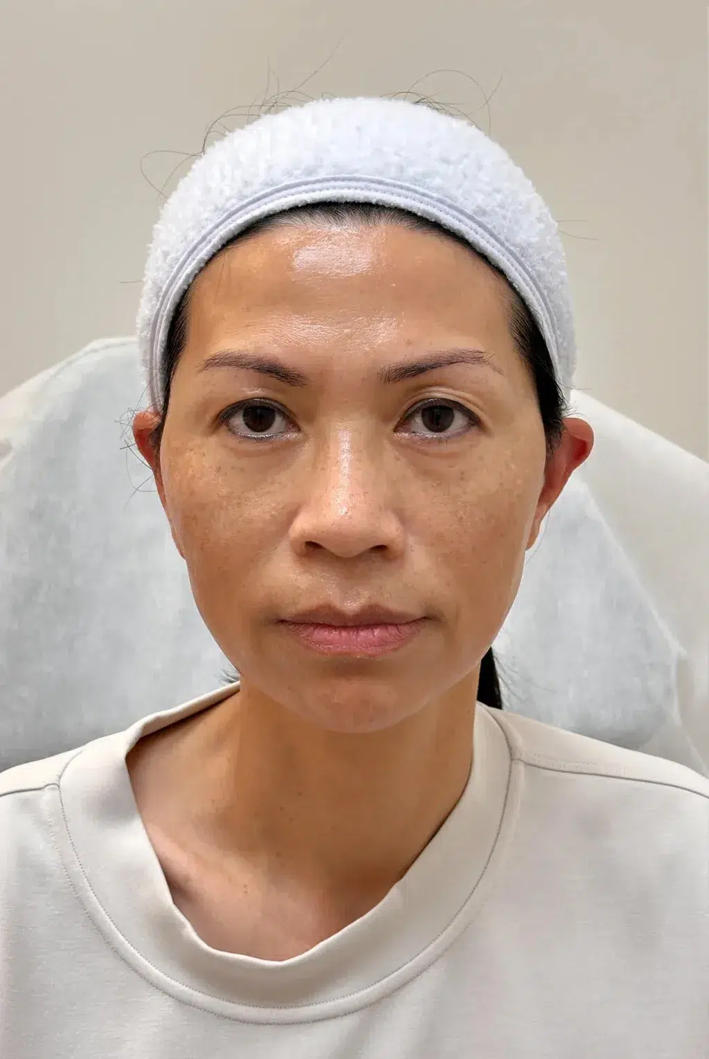 Facial Fatigue / Aged Appearance / Dull Complexion — Before · Case 03 · Luowei Medical Aesthetics Clinic