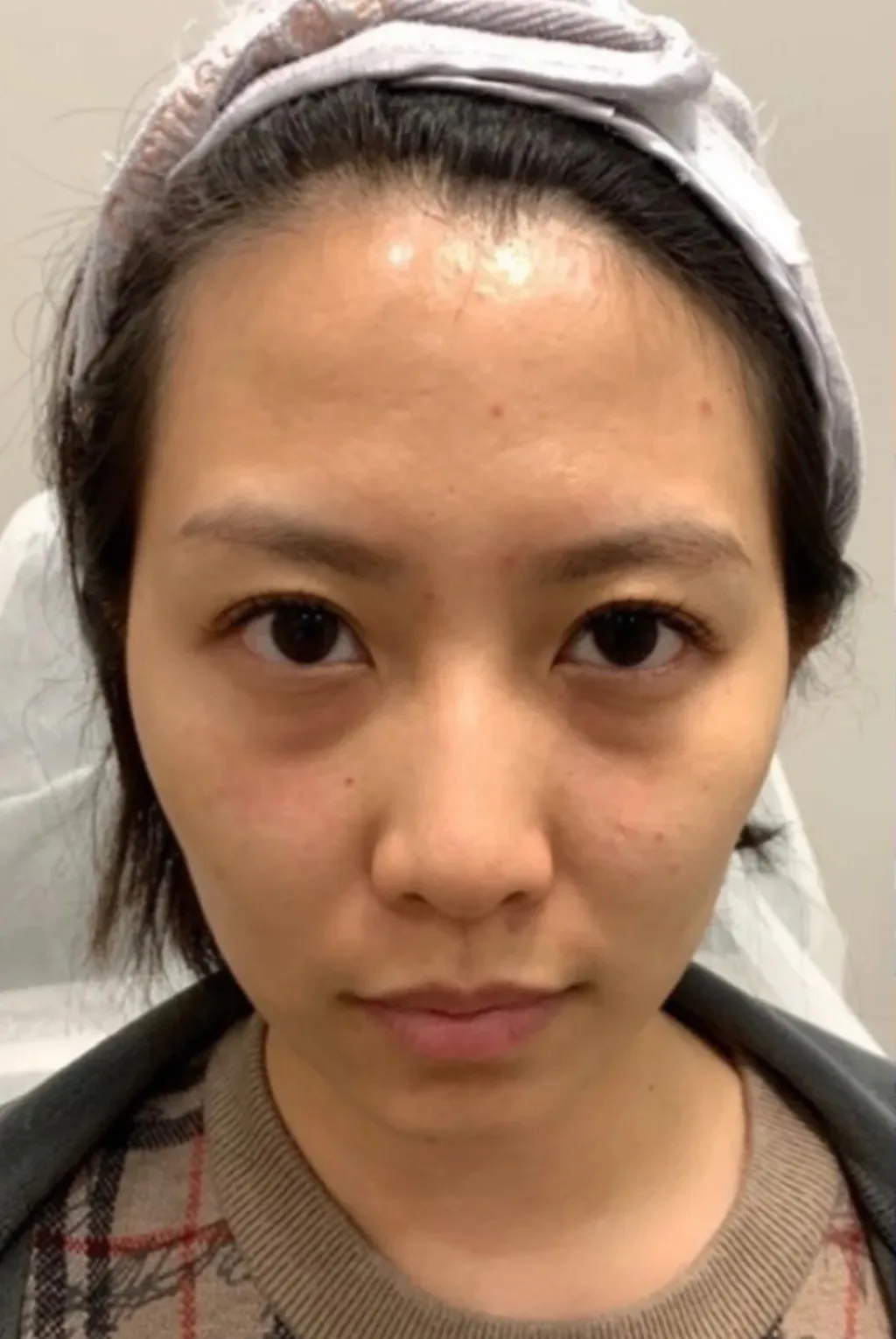 Facial Fatigue / Aged Appearance / Tired Look — Before · Case 04 · Luowei Medical Aesthetics Clinic