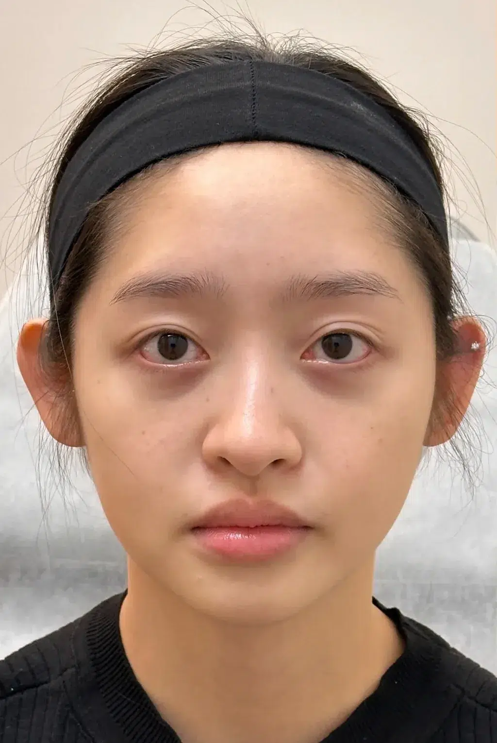 Under-Eye Bags & Dark Circles — Before Treatment · Case 13 · Luowei Medical Aesthetics Clinic