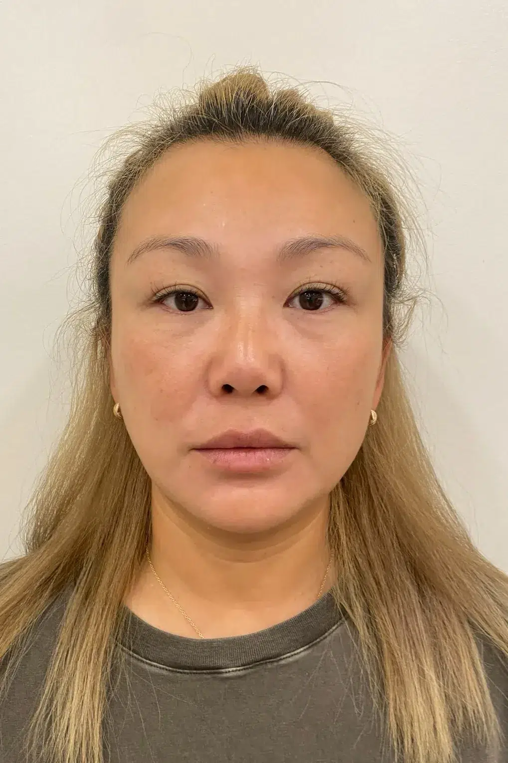 Tired, Aged & Fatigued Appearance — Before Treatment · Case 08 · Luowei Medical Aesthetics Clinic