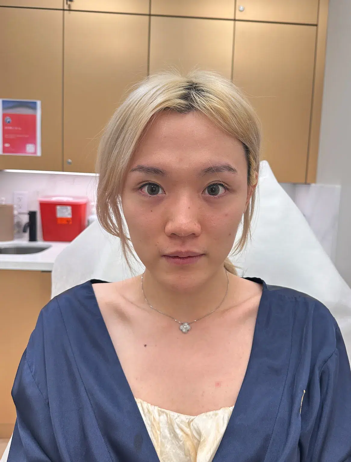 Upper Eyelid Ptosis — Before · Case 09 · Luowei Medical Aesthetics Clinic
