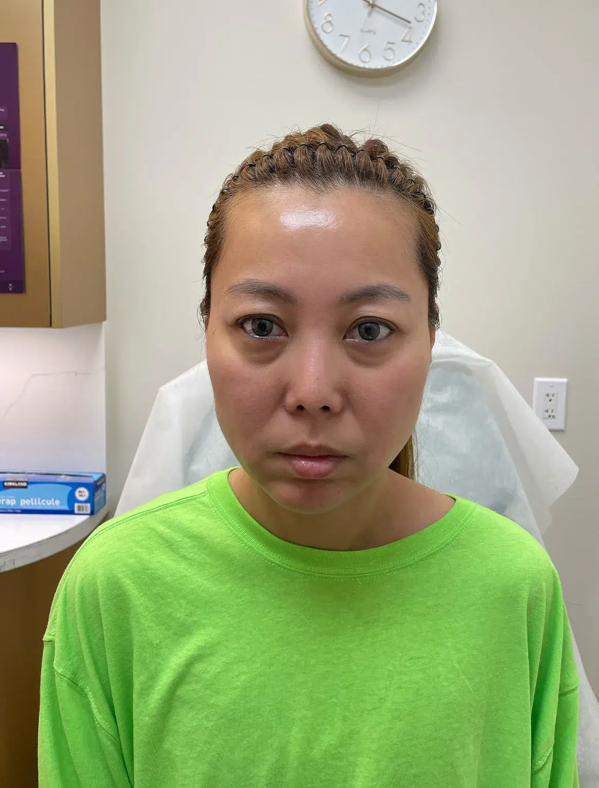 Facial Fatigue / Aged Appearance / Dull Complexion — Before · Case 10 · Luowei Medical Aesthetics Clinic