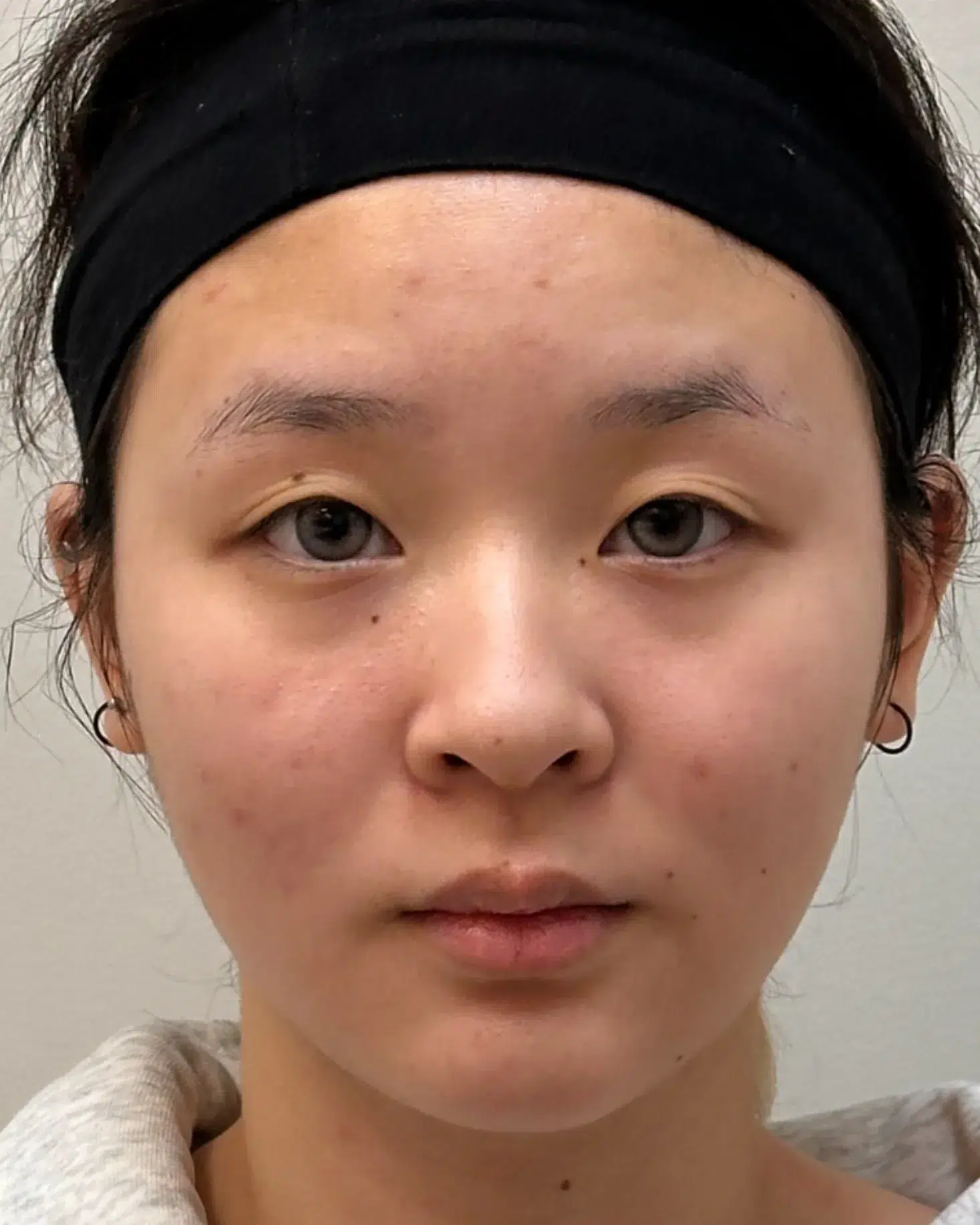 Luowei Facial Sculpturing · Before · Case 101 · Luowei Medical Aesthetics Clinic