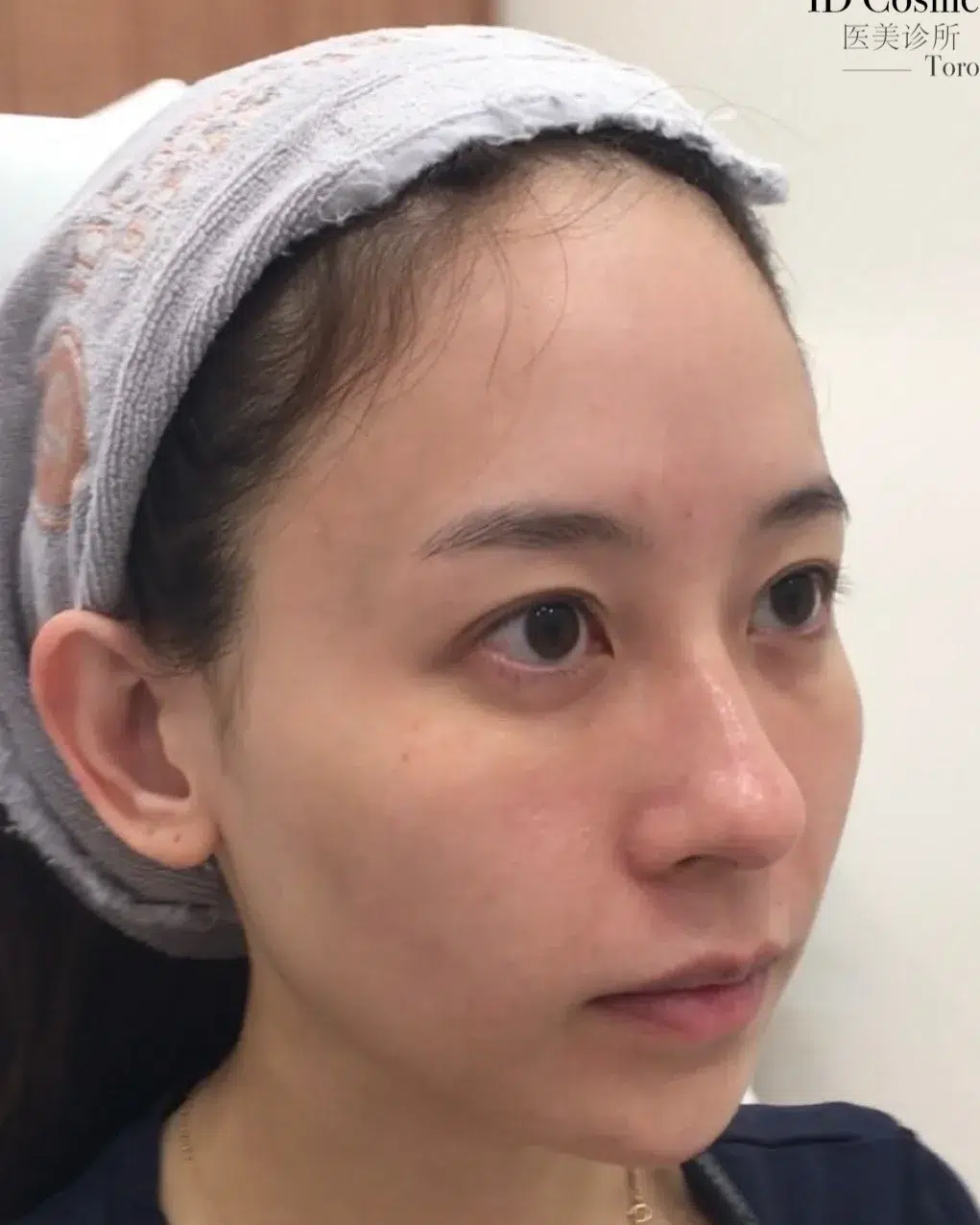 Tear Trough — Before Treatment · Case 104 · Luowei Medical Aesthetics Clinic