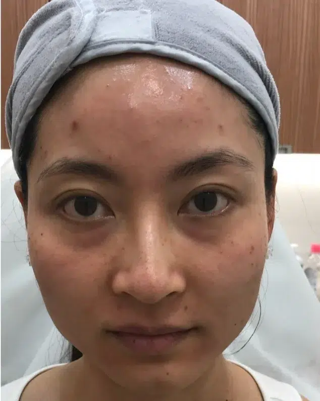 Facial Fatigue / Aged Appearance / Dull Complexion — Before · Case 106 · Luowei Medical Aesthetics Clinic