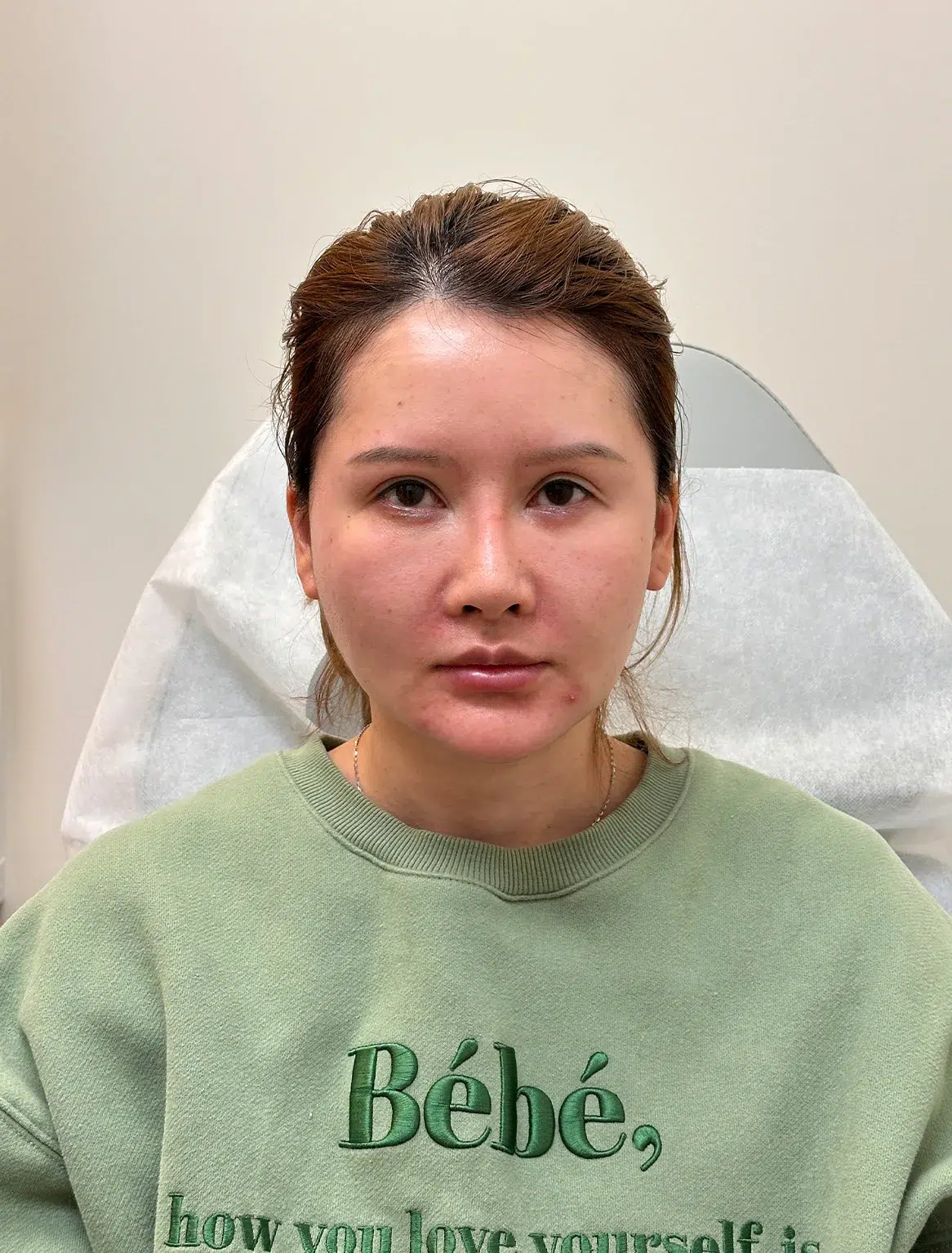 Facial Fatigue / Aged Appearance / Tired Look — Before · Case 11 · Luowei Medical Aesthetics Clinic