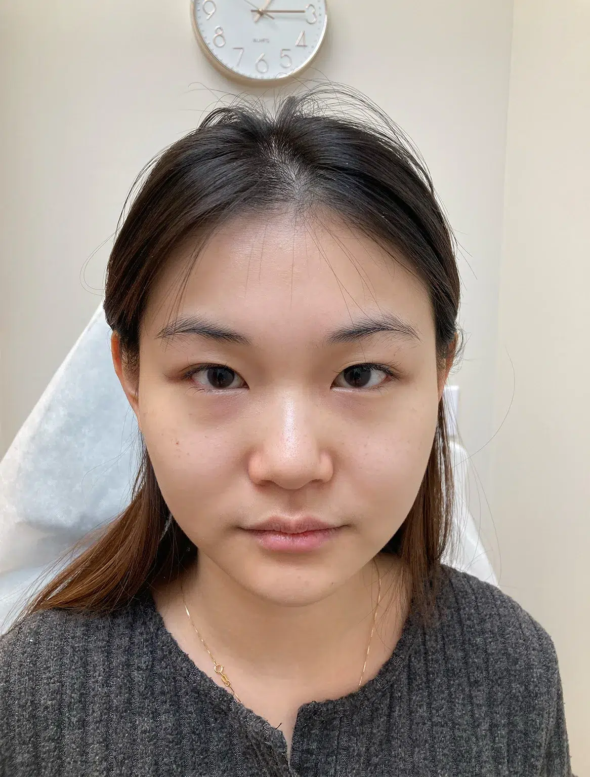 Ptosis (upper eyelid droop) — Before · Case 13 · Luowei Medical Aesthetics Clinic