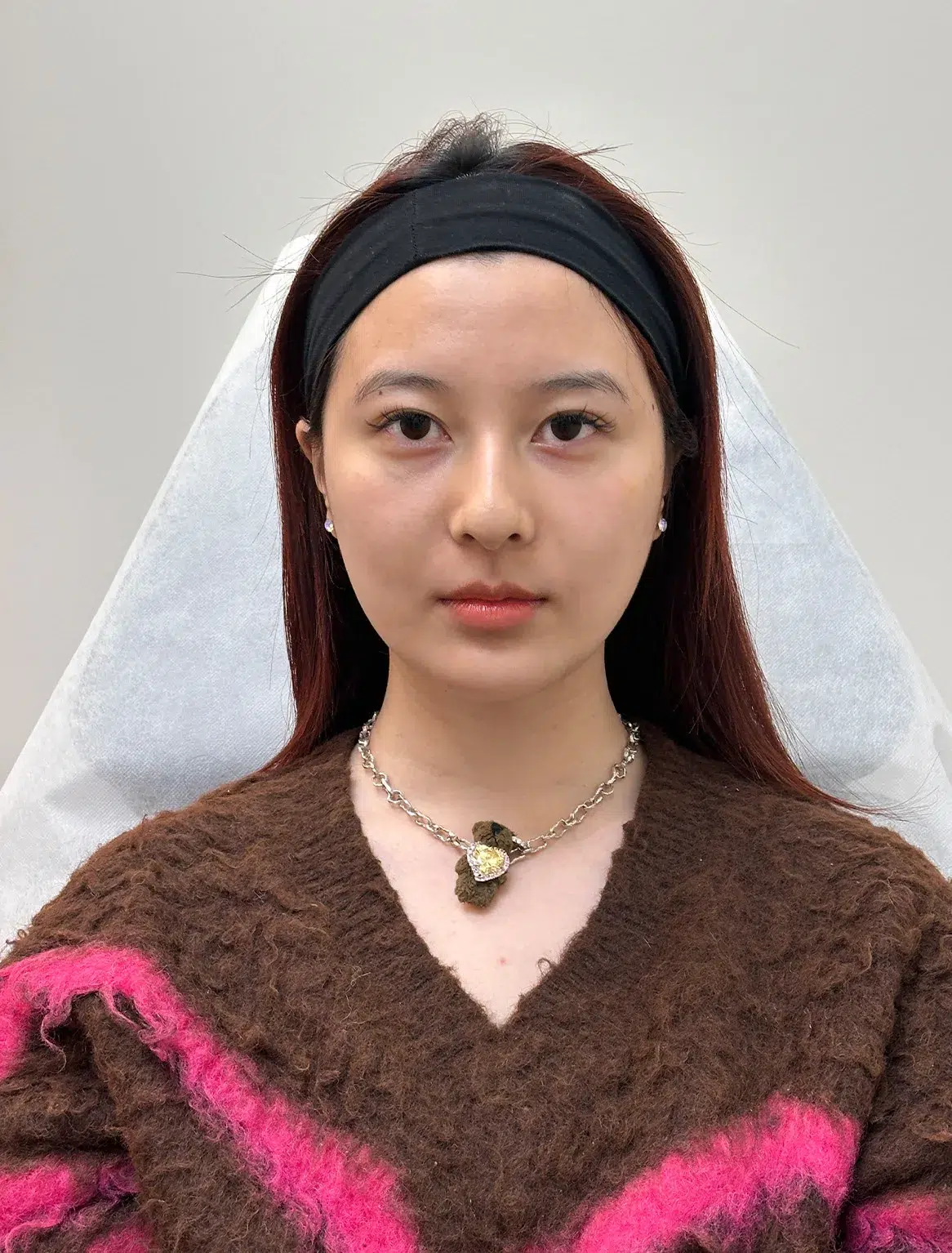Tired, Aged & Fatigued Appearance — Before Treatment · Case 14 · Luowei Medical Aesthetics Clinic