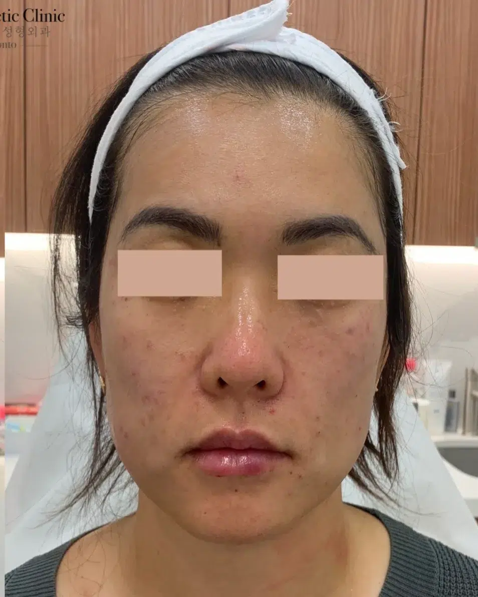Lip Enhancement — After · Case 01 · Luowei Medical Aesthetics Clinic