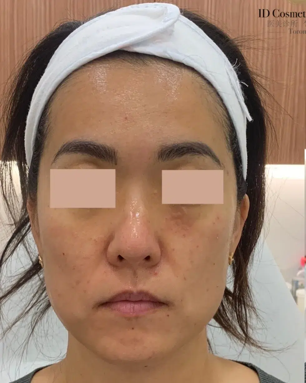 Lip Enhancement — Before · Case 01 · Luowei Medical Aesthetics Clinic