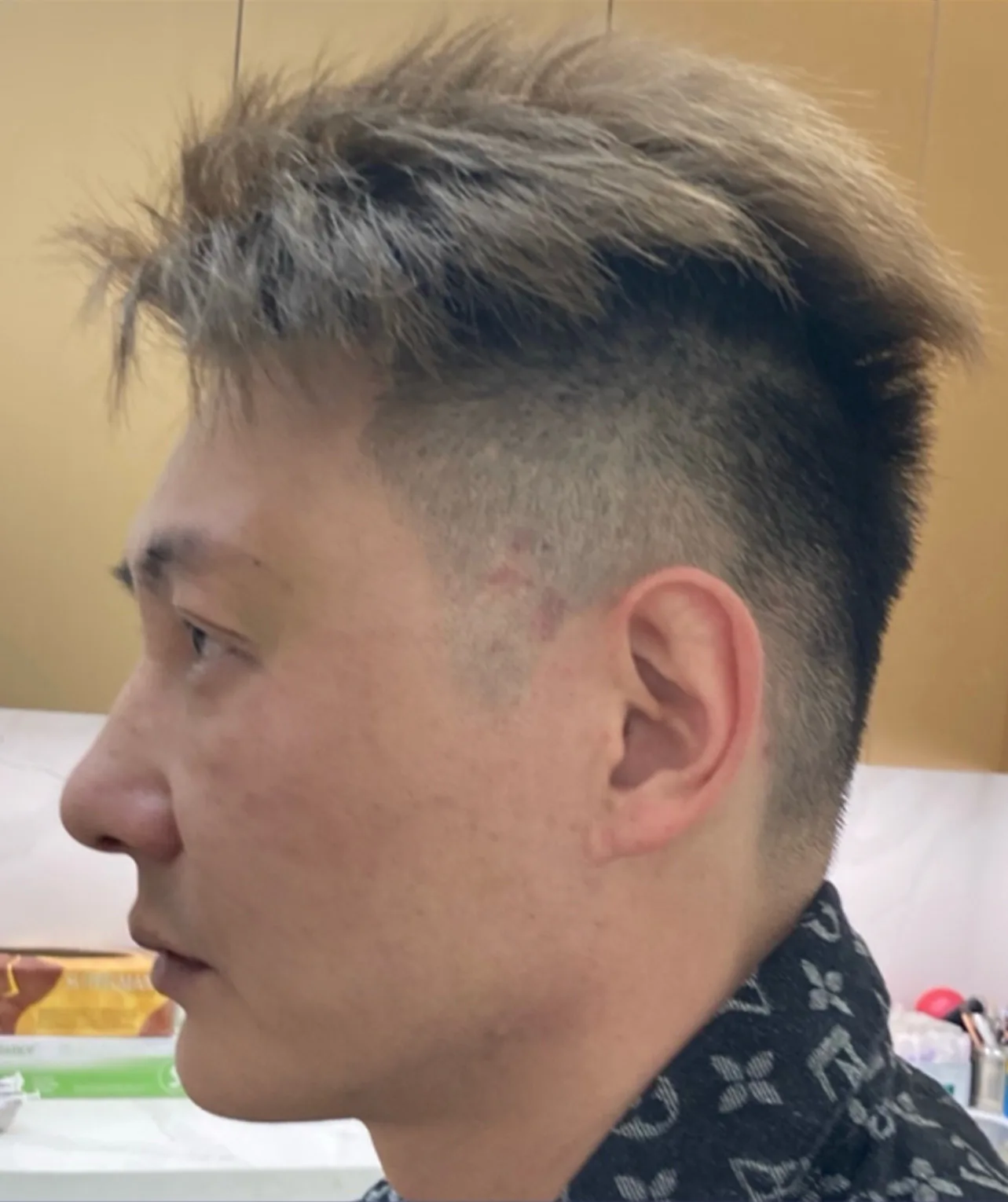 Ptosis (upper eyelid droop) — After · Case 04 · Luowei Medical Aesthetics Clinic