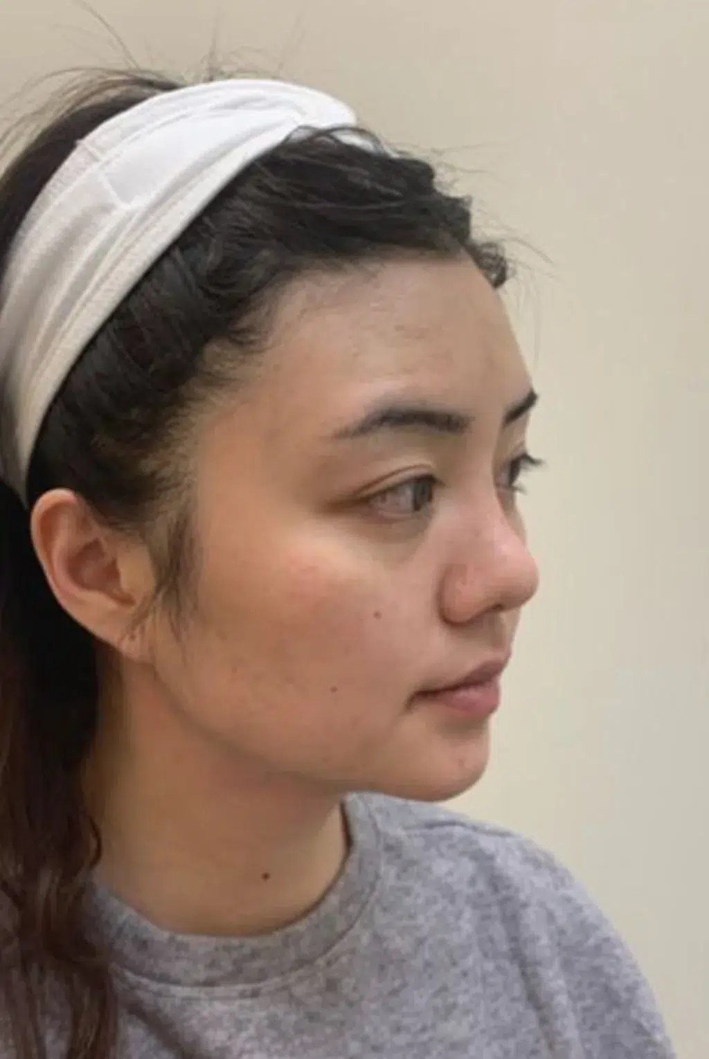 Ptosis (upper eyelid droop) — After · Case 07 · Luowei Medical Aesthetics Clinic