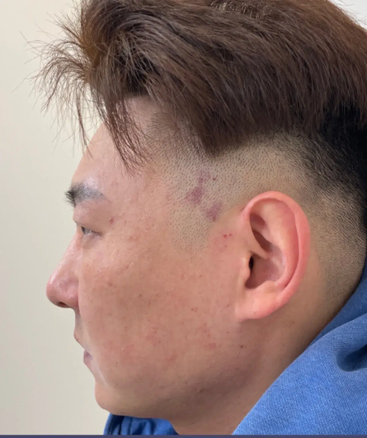 Ptosis (upper eyelid droop) — Before · Case 04 · Luowei Medical Aesthetics Clinic