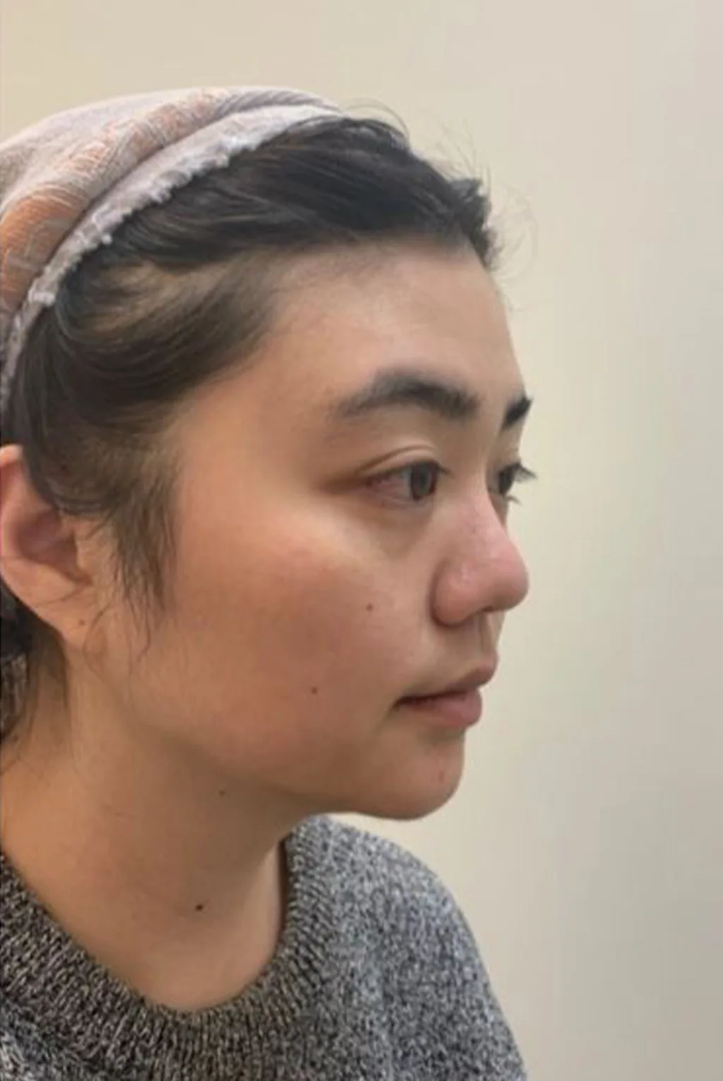 Ptosis (upper eyelid droop) — Before · Case 07 · Luowei Medical Aesthetics Clinic