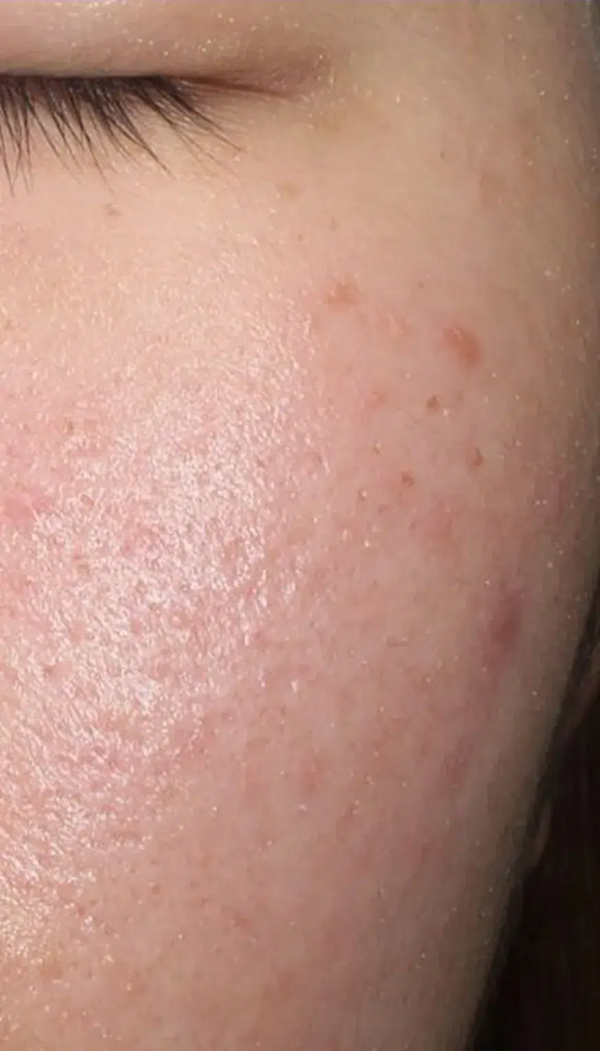 Facial Redness / Broken Capillaries — After · Case 1 · Luowei Medical Aesthetics Clinic