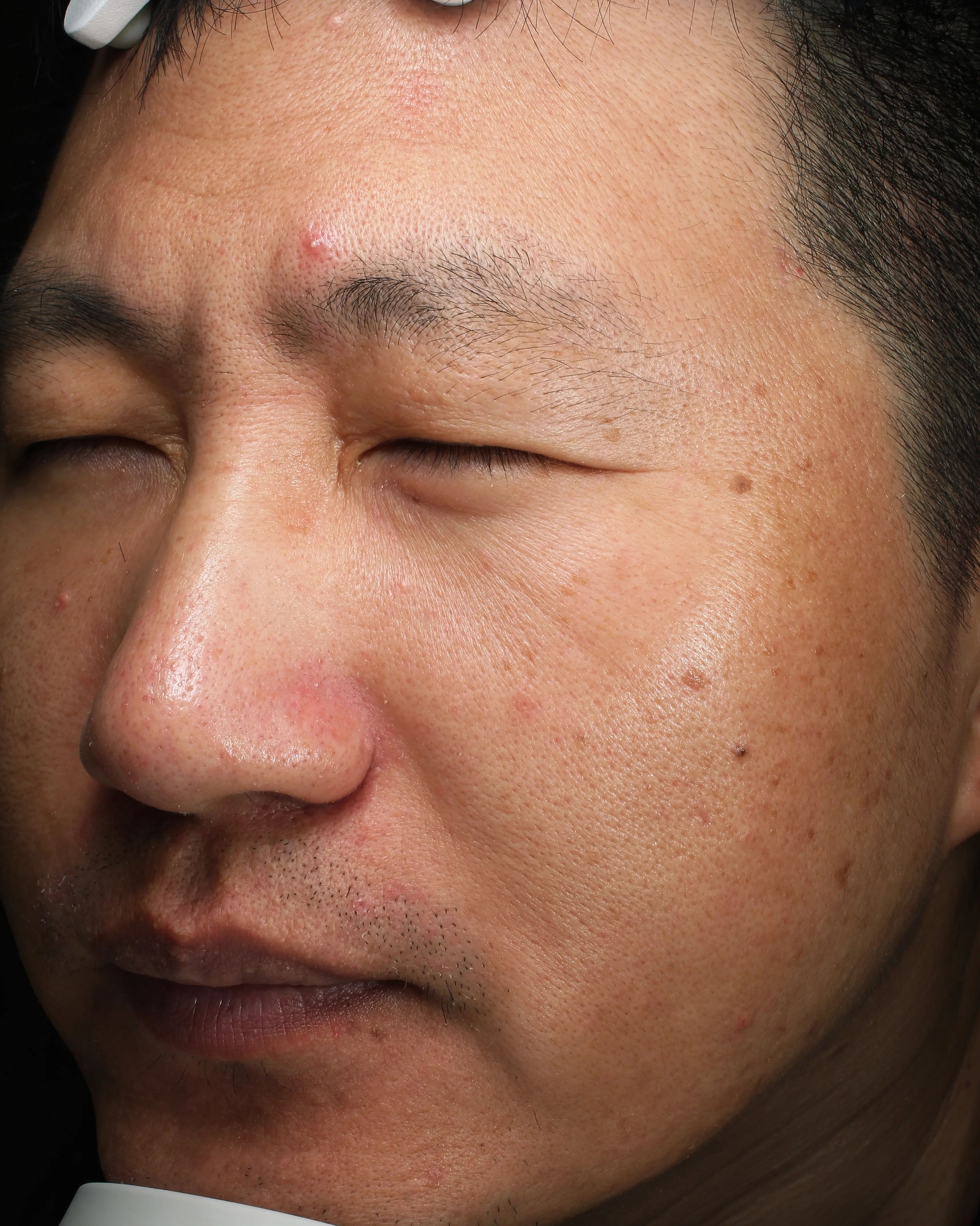 Rosacea Redness — After Treatment · Case 03 · Luowei Medical Aesthetics Clinic