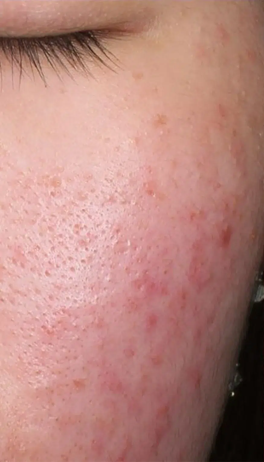 Facial Redness · Visible Capillaries — Before · Case 1 · Luowei Medical Aesthetics Clinic