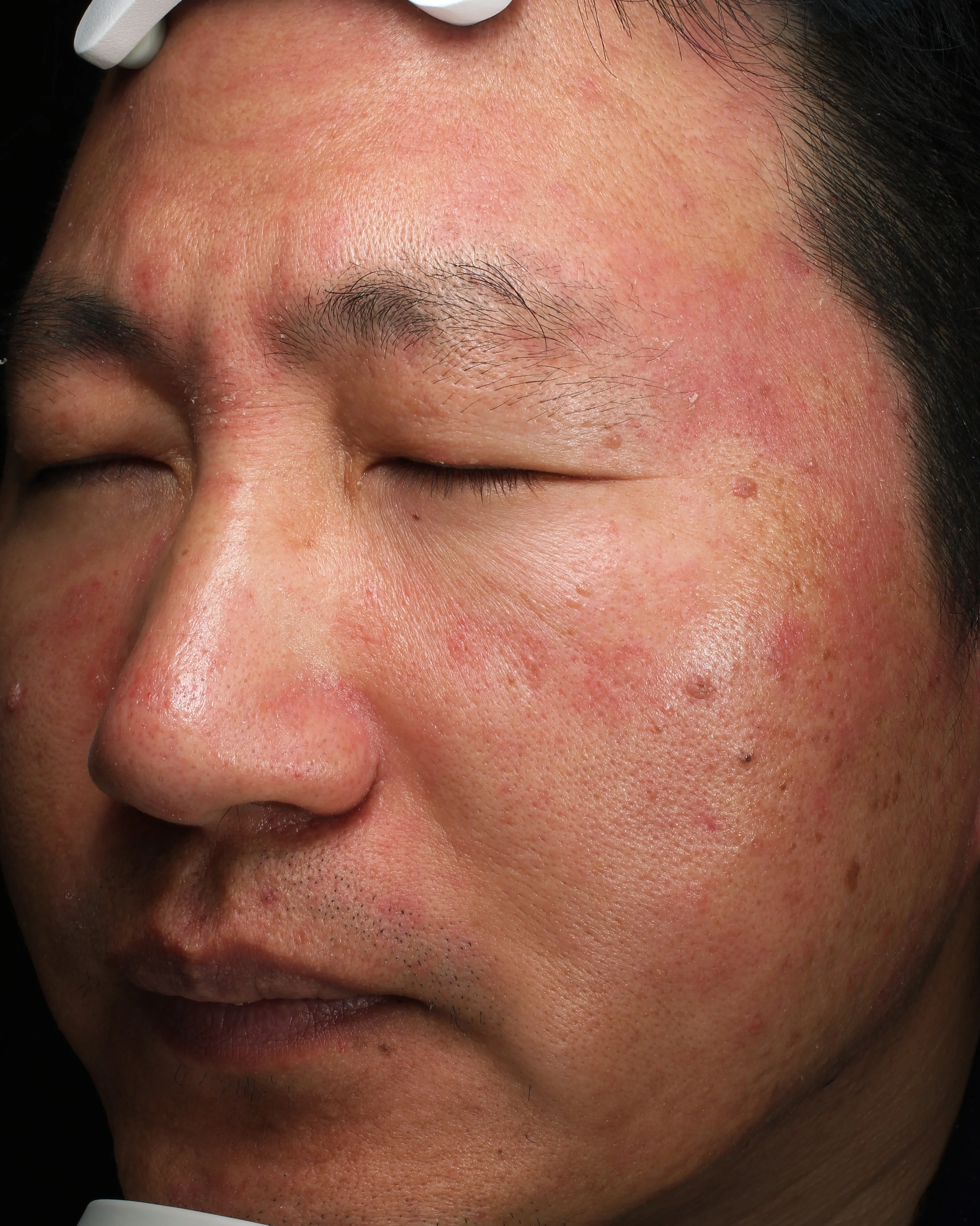 Rosacea Redness Before Treatment · Case 03 · Luowei Medical Aesthetics Clinic