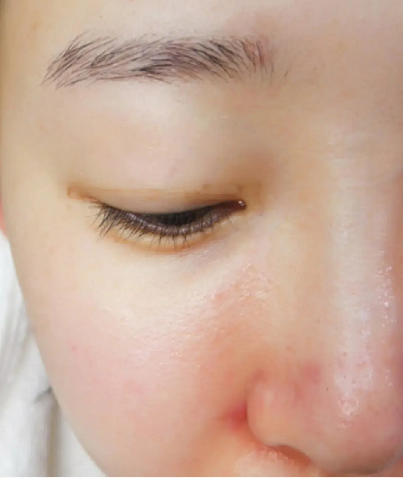 Pigmentation pre-treatment · Case 04 · Luowei Medical Aesthetics Clinic