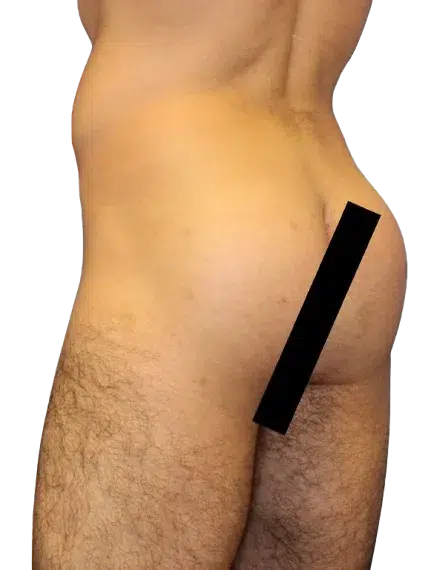 Flat Buttock — After Treatment · Case 04 · Luowei Medical Aesthetics Clinic