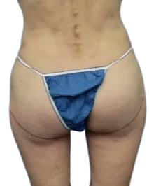 Flat Buttock — After Treatment · Case 10 · Luowei Medical Aesthetics Clinic