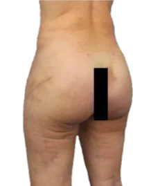 Flat Buttock — After Treatment · Case 27 · Luowei Medical Aesthetics Clinic