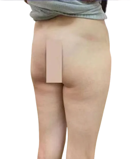 Flat Buttock — Before · Case 01 · Luowei Medical Aesthetics Clinic