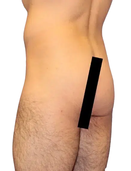 Flat Buttock — Before · Case 04 · Luowei Medical Aesthetics Clinic