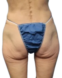 Flat Buttock — Before Treatment · Case 10 · Luowei Medical Aesthetics Clinic