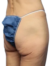Flat Buttock — Before Treatment · Case 11 · Luowei Medical Aesthetics Clinic