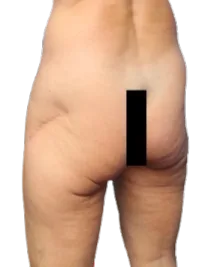 Flat Buttock — Before · Case 27 · Luowei Medical Aesthetics Clinic
