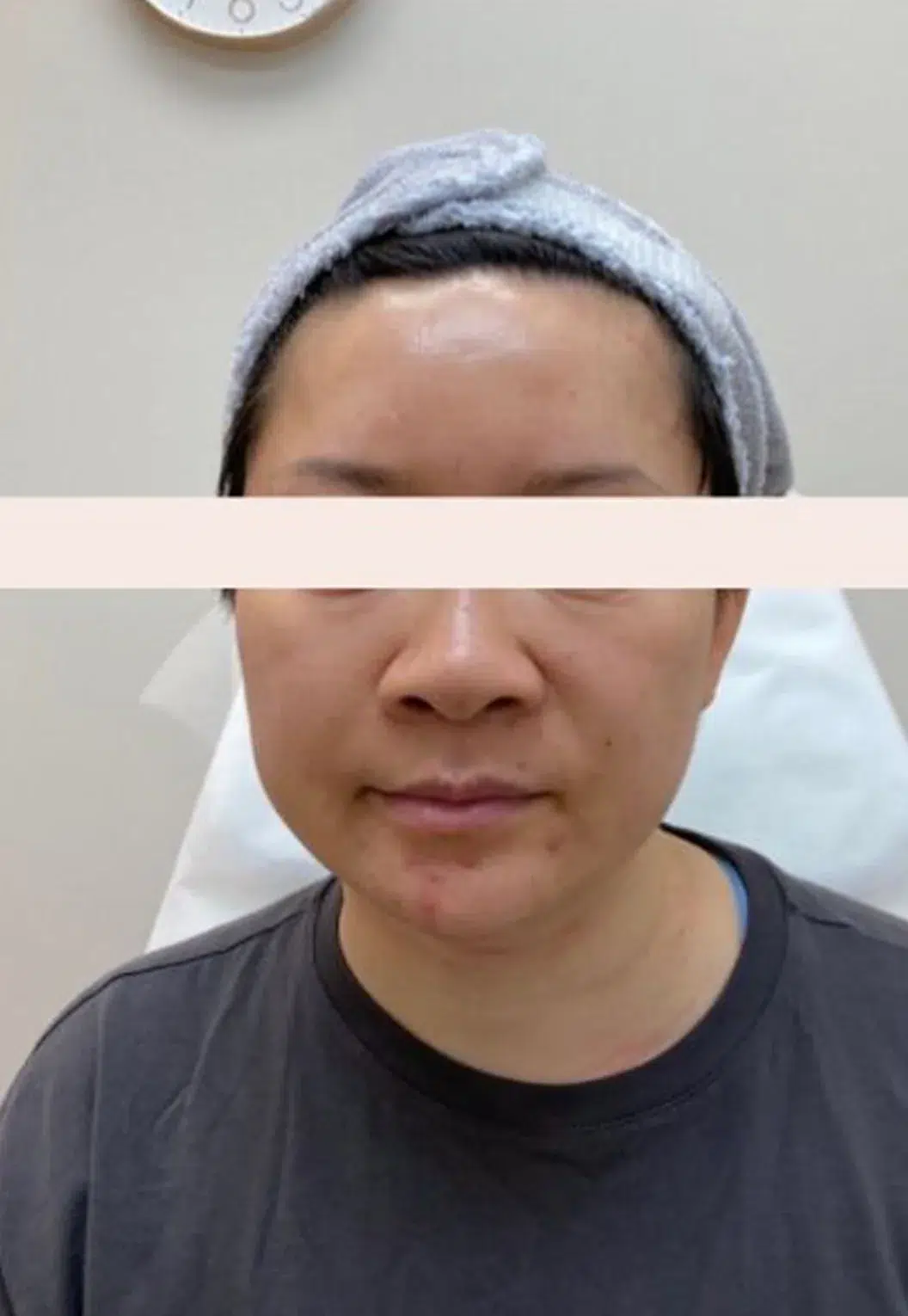 Forehead Depression After Treatment · Case 1 · Luowei Medical Aesthetics Clinic