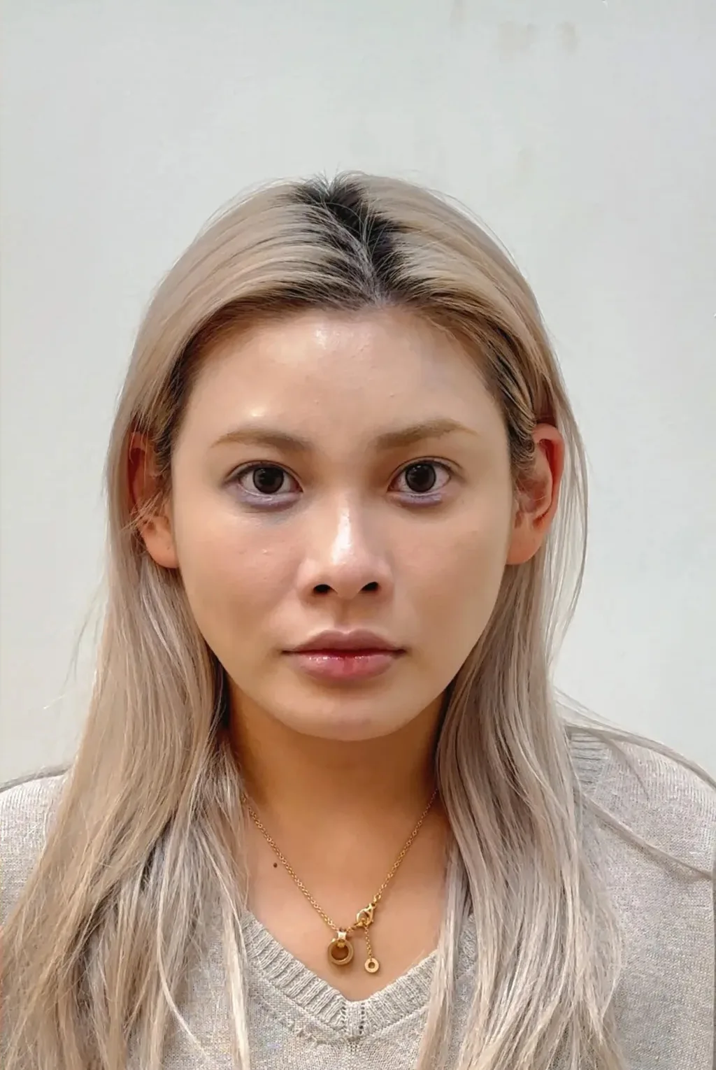 Lip Augmentation — After · Case 02 · Luowei Medical Aesthetics Clinic
